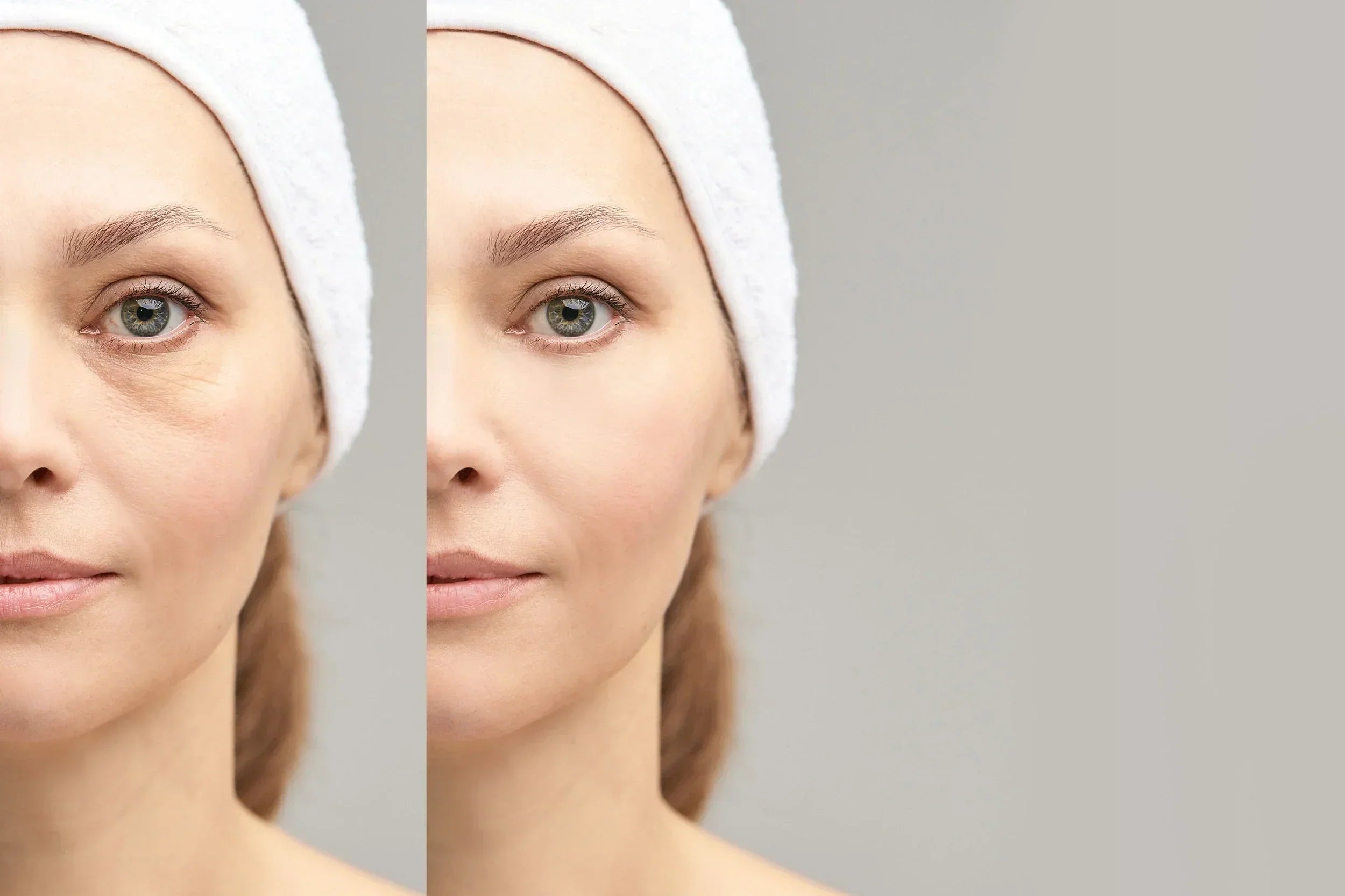 What is the Best Dermal Filler for Under Eyes?