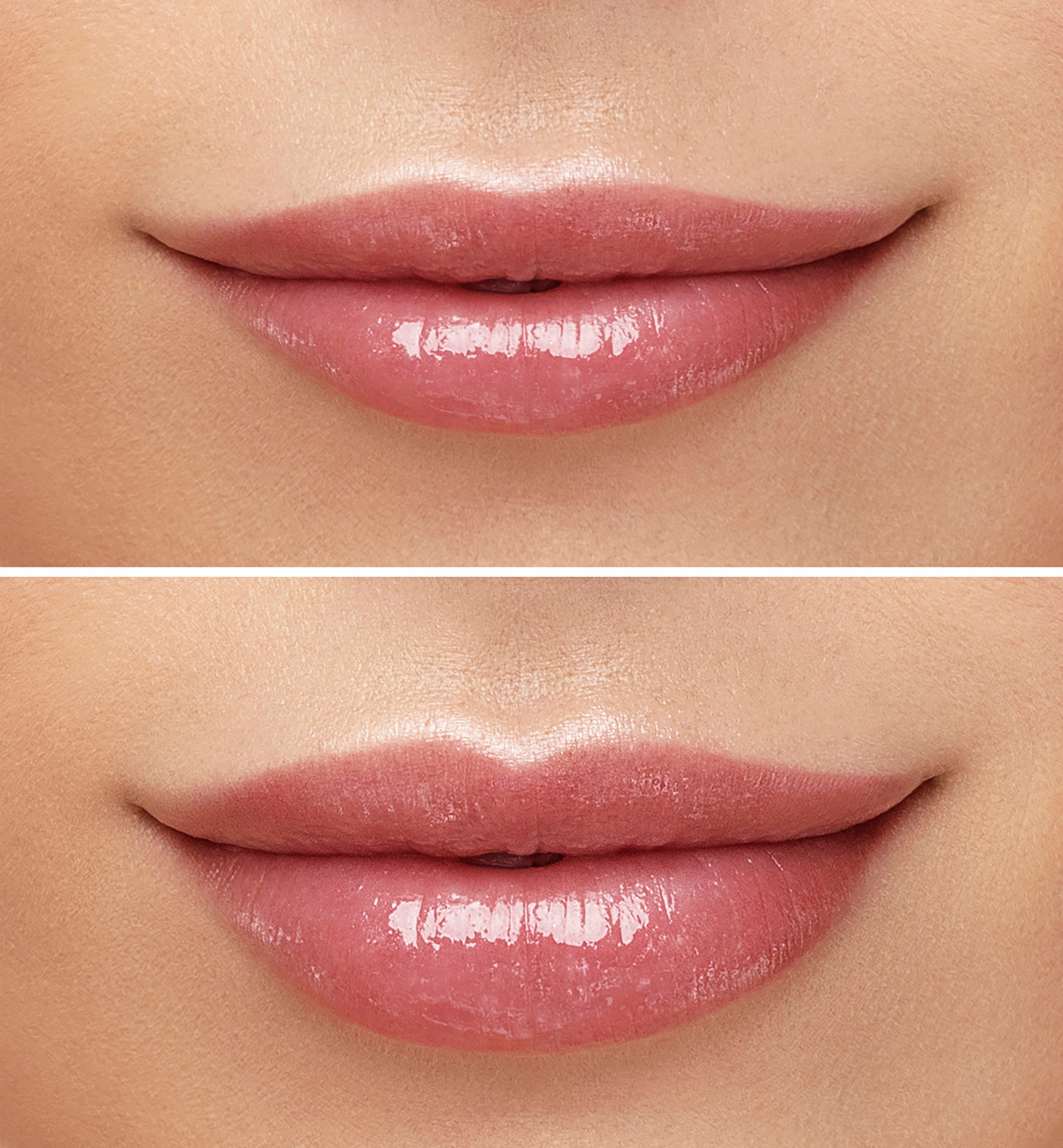 Lip Flip vs. Lip Filler: Which Option Is Right for You?
