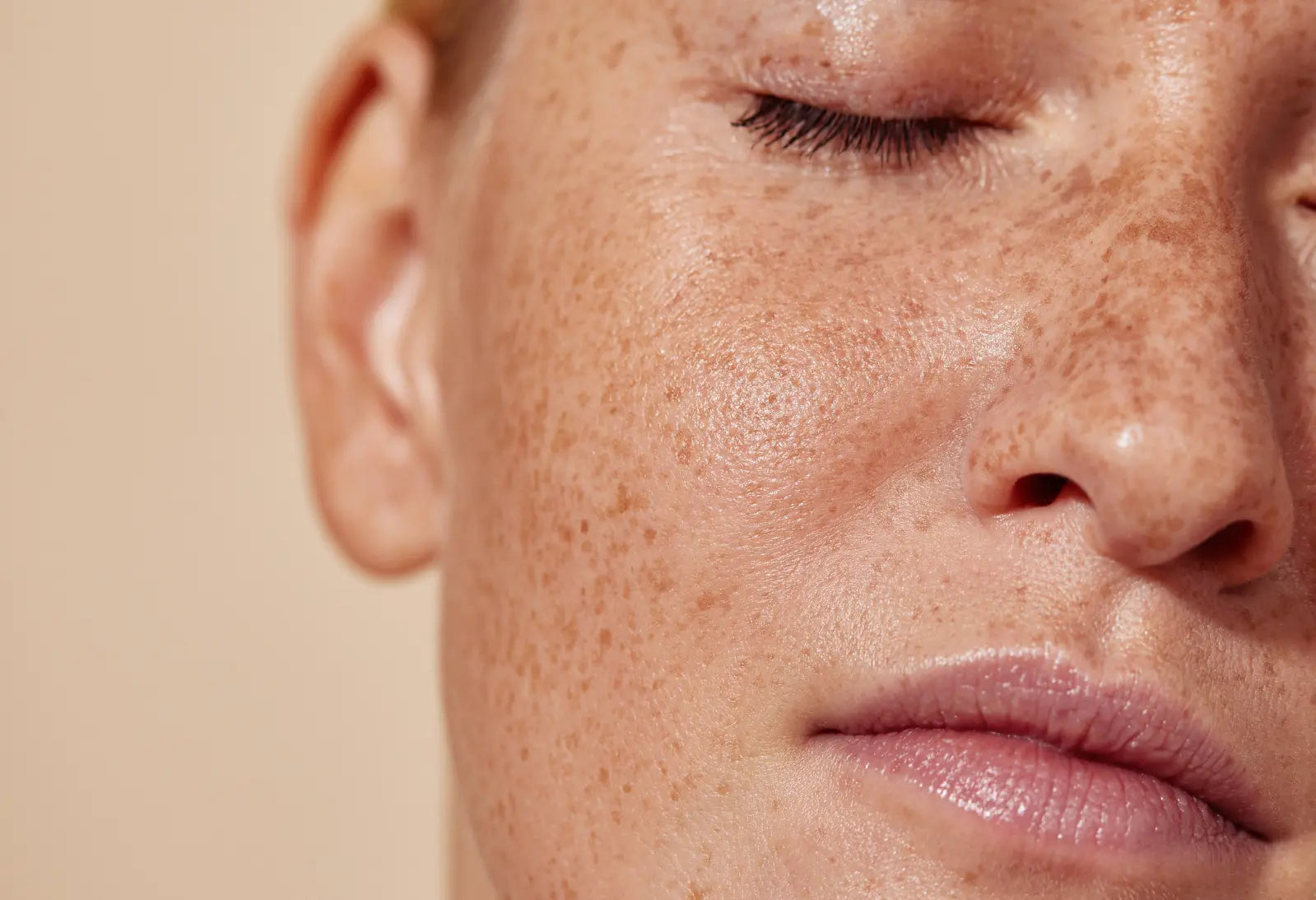 Microneedling for Acne Scars Treatment