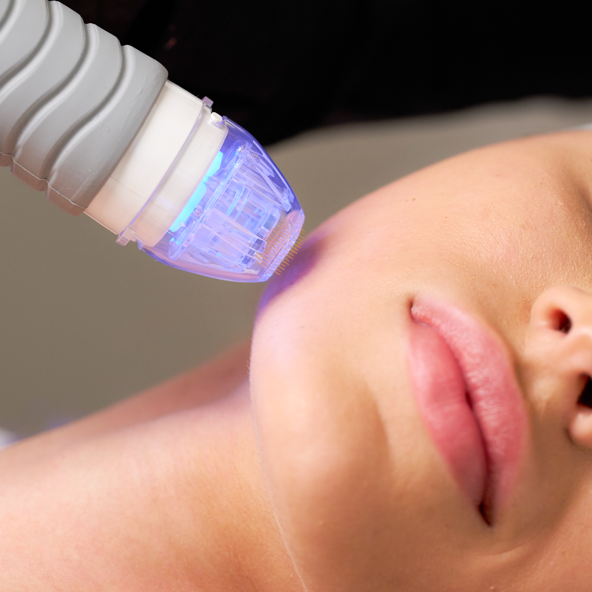 The Best Treatments for Uneven Skin Texture and Which One Is Right for You