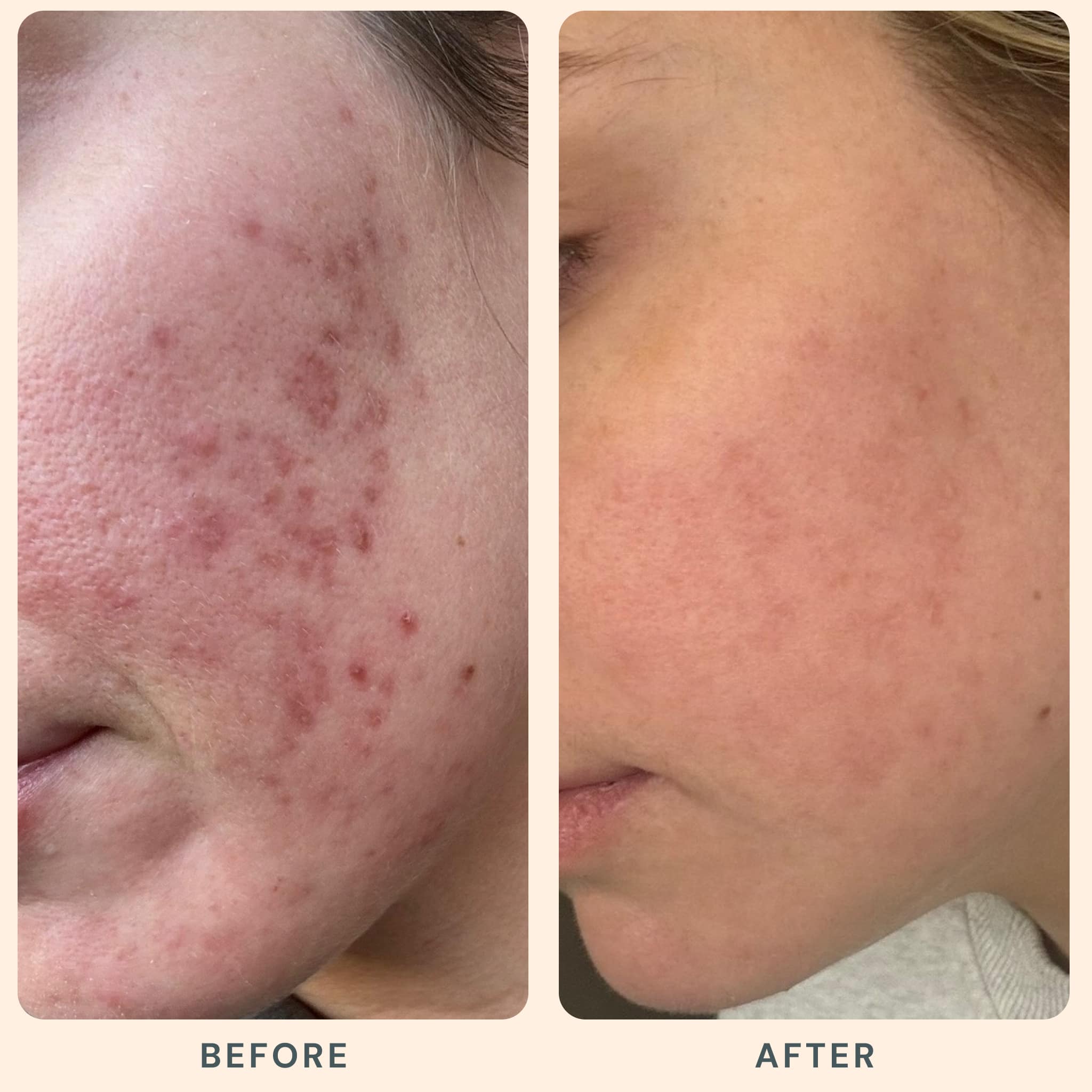 What Are the Best Skin Treatments for Acne Scars?