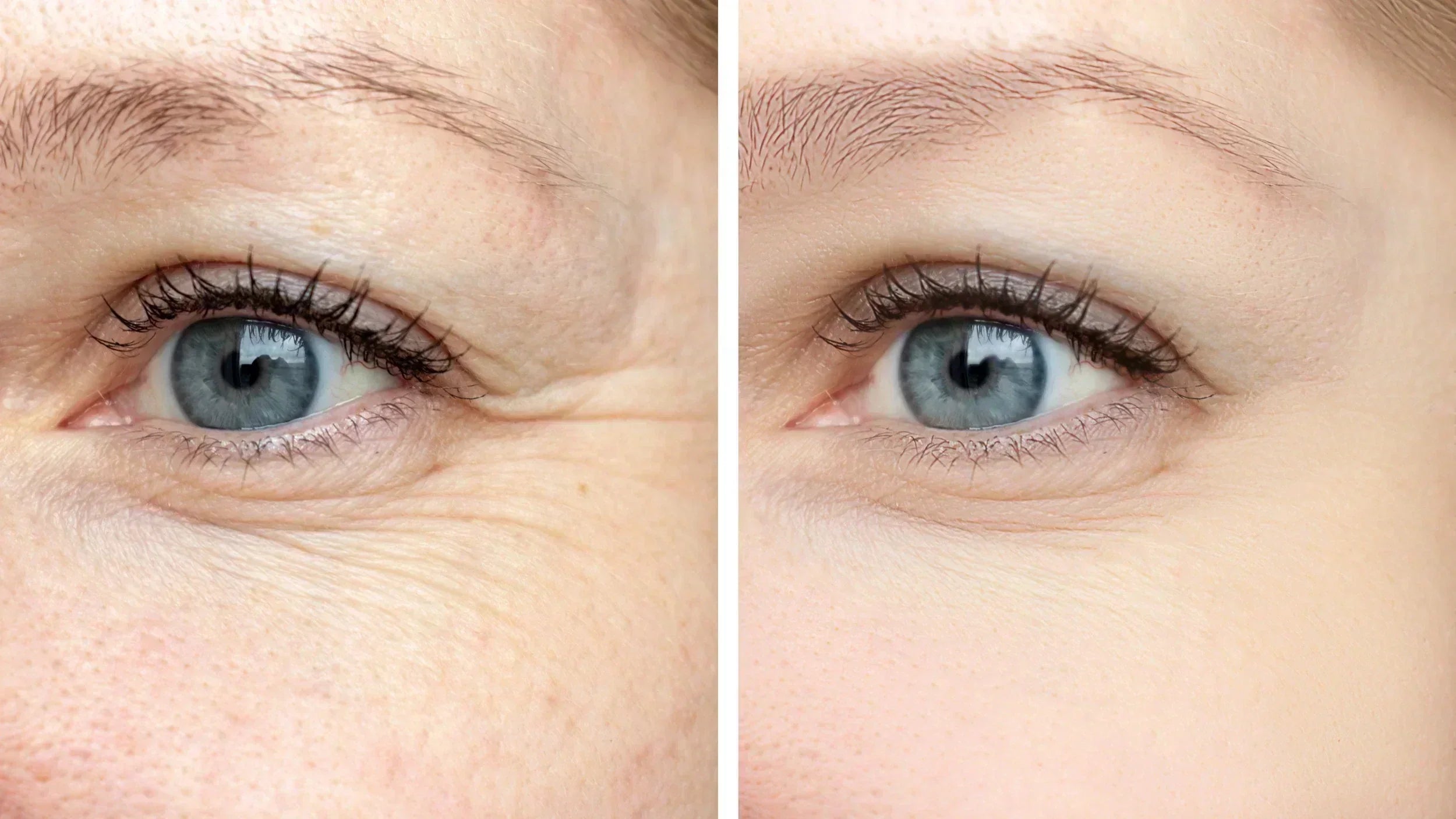Dysport vs. Botox: How a Provider Decides Which One Is Right for You