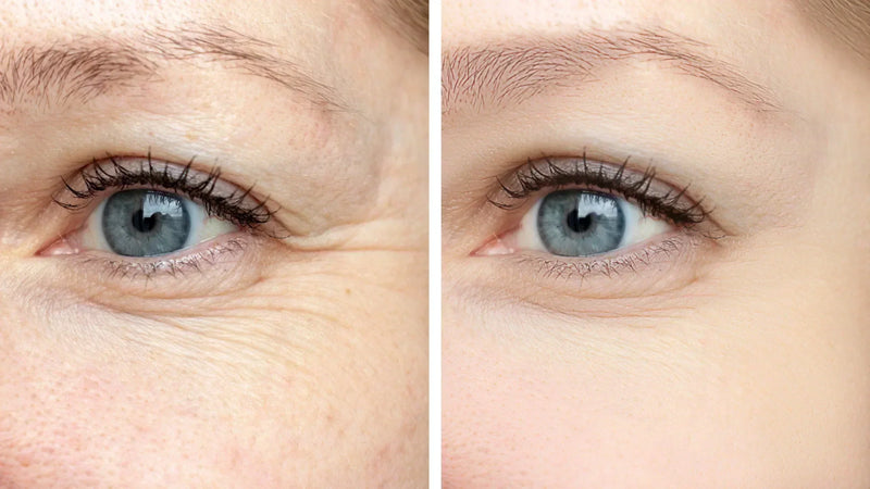 Dysport vs. Botox: How a Provider Decides Which One Is Right for You