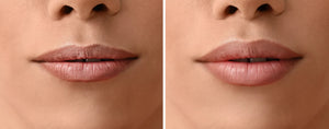 How Long Does It Take for Lip Filler to Settle? Understanding the Timeline