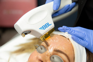 The Bright Side of Beauty: Everything You Need to Know About BBL Photofacials