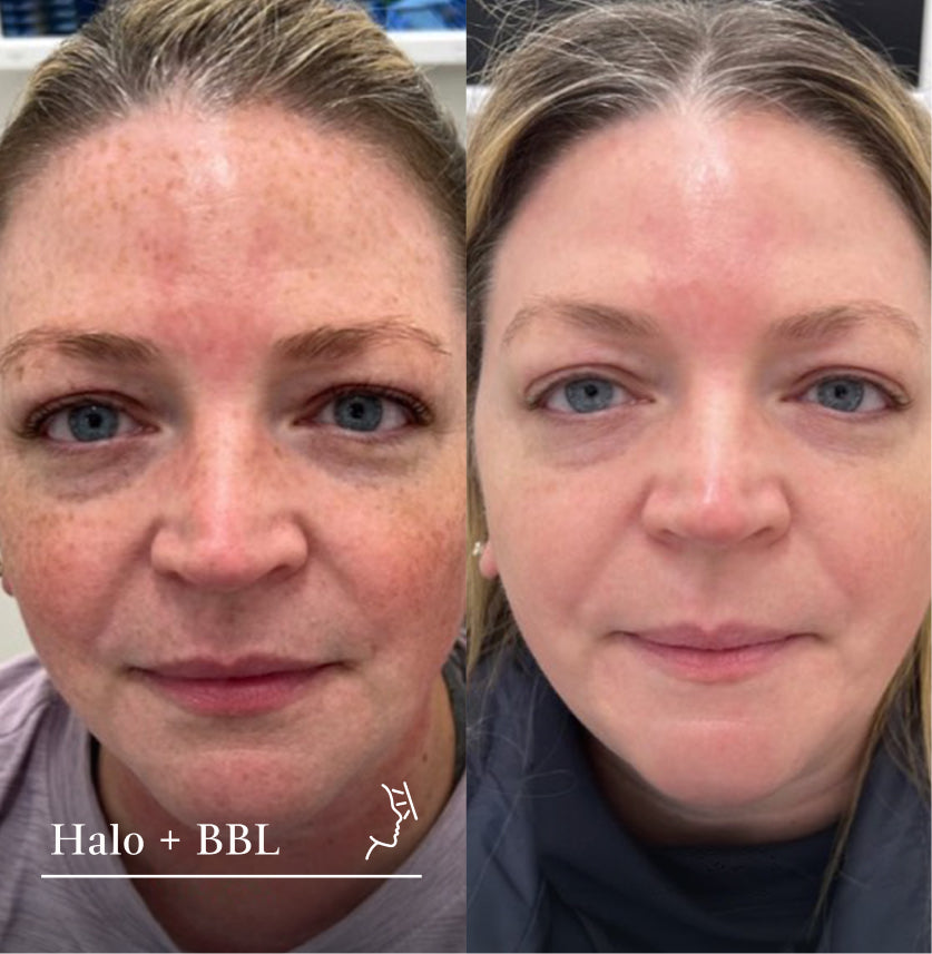 The Beauty of Cosmetic Lasers & Light Therapy: BBL & Halo Explained