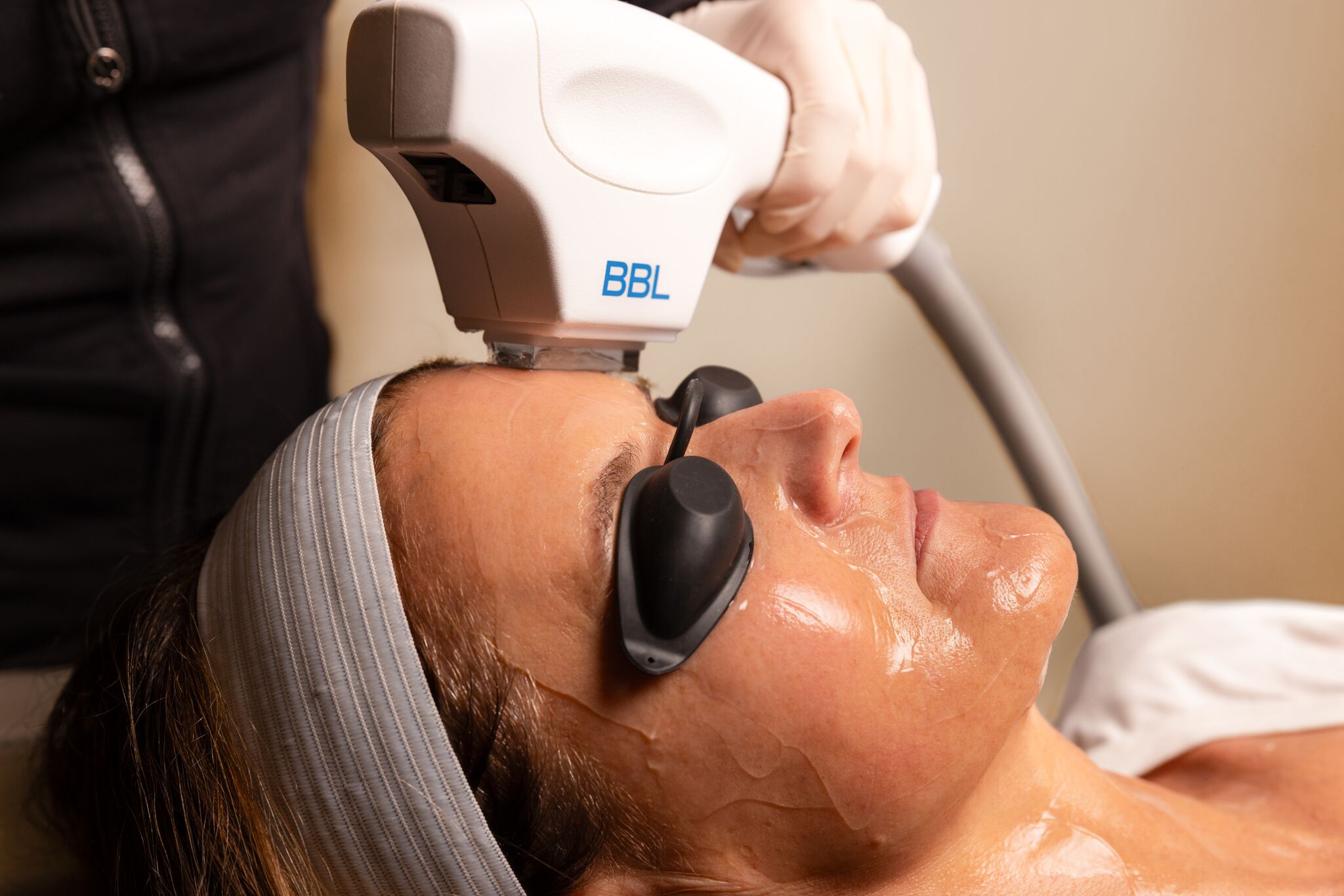 MOXI vs BBL Photofacial: Color, Texture, and Which You Need First