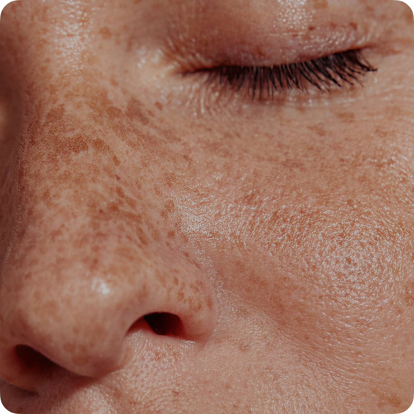 Nasolabial Folds before