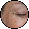 Fine Lines/Wrinkles