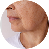Aging Skin
