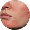 Redness and Sensitivity