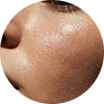 Hydration and Moisture