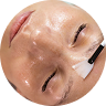 Chemical Peels