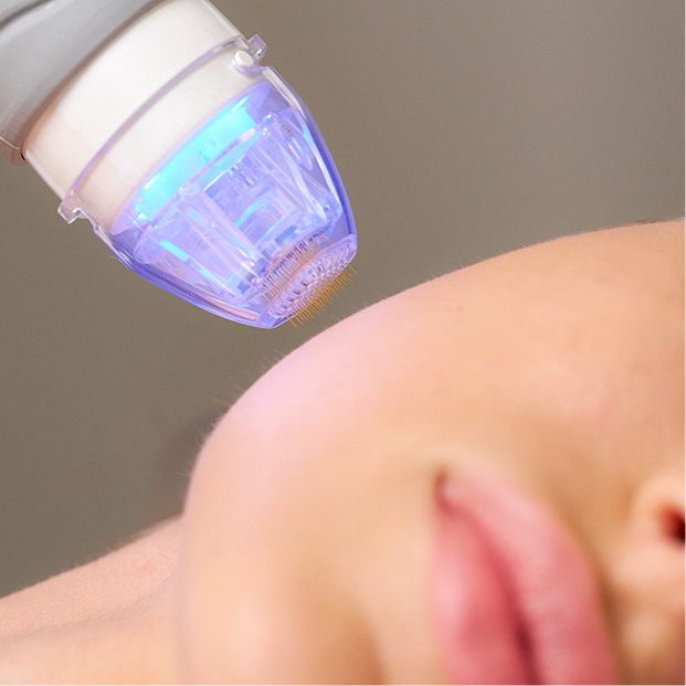 RF Microneedling